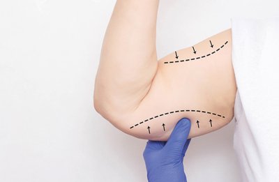 Lifting des cuisses ou des bras