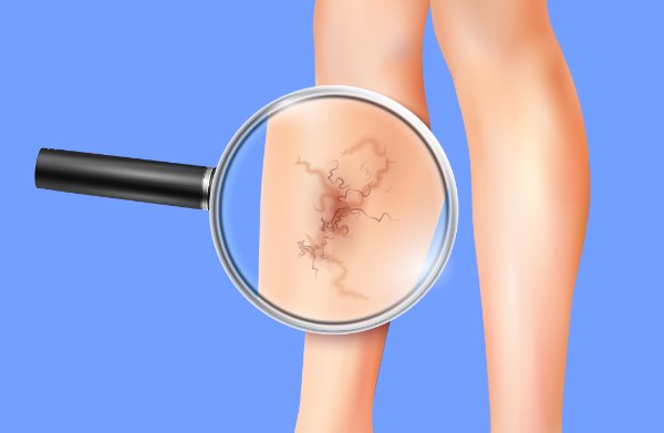 Traitement des varicosités et couperose par Laser